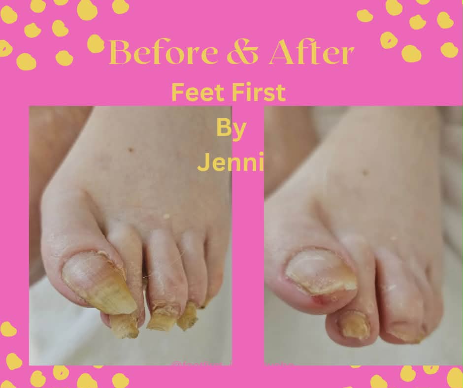 Before and after foot care